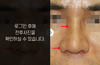 낮은코성형