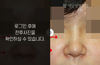 낮은코성형