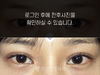 절개법 쌍꺼풀수술