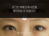 절개법 쌍꺼풀수술+앞트임