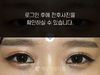 절개법 쌍꺼풀수술+앞트임