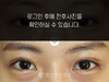 눈재수술