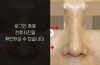 매부리코성형