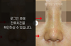 코재수술