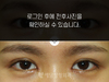 매몰법 쌍꺼풀수술+앞트임