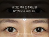 눈재수술