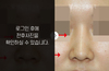 낮은코성형