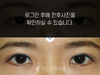매몰법 쌍꺼풀수술