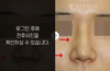 낮은코성형