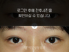 부분절개법 쌍꺼풀수술
