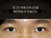 매몰법 쌍꺼풀수술