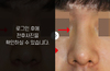 낮은코성형