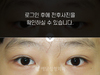 부분절개 쌍꺼풀수술