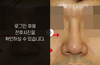 낮은코성형