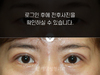 상안검수술