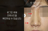 매부리코성형