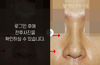 낮은코성형