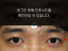 매몰법 쌍꺼풀수술+앞트임