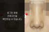 낮은코성형