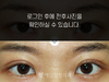부분절개법 쌍꺼풀수술