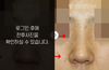 매부리코성형