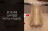 낮은코성형