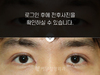 절개법 쌍꺼풀수술+앞트임