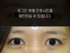 절개법 쌍꺼풀수술+앞트임
