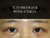 매몰법 쌍꺼풀수술+앞트임