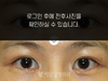 앞트임
