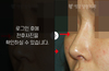 매부리코성형