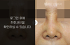 코재수술(염증코)