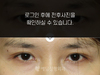 매몰법 쌍꺼풀수술