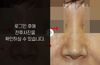 짧은코성형