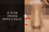 휜코성형