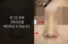 낮은코성형