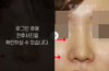 코재수술(보형물 비뚤어짐)