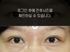 절개법 쌍꺼풀수술