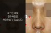 매부리코성형