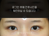 절개법 쌍꺼풀수술+앞트임