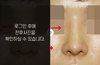 낮은코성형
