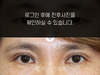 상안검수술