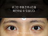 절개법 쌍꺼풀수술+앞트임