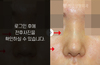 낮은코성형
