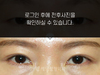 절개법 쌍꺼풀수술
