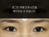 절개법 쌍꺼풀수술+앞트임