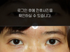매몰법 쌍꺼풀수술