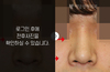낮은코성형