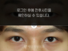 매몰법 쌍꺼풀수술