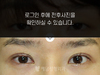 매몰법 쌍거풀수술